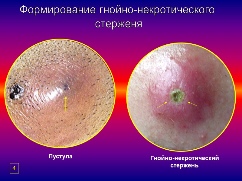 Формирование гнойно-некротического  стерженя Пустула Гнойно-некротический стержень 4